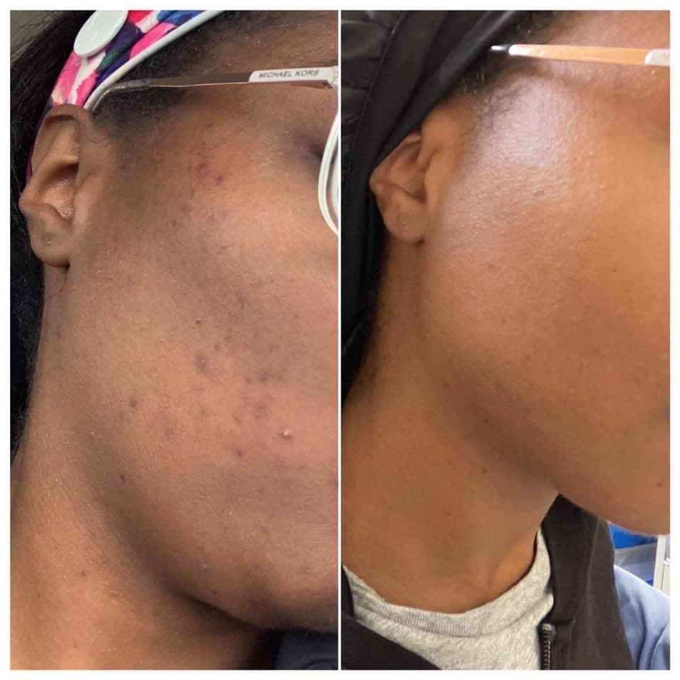 Acne Scarring results
