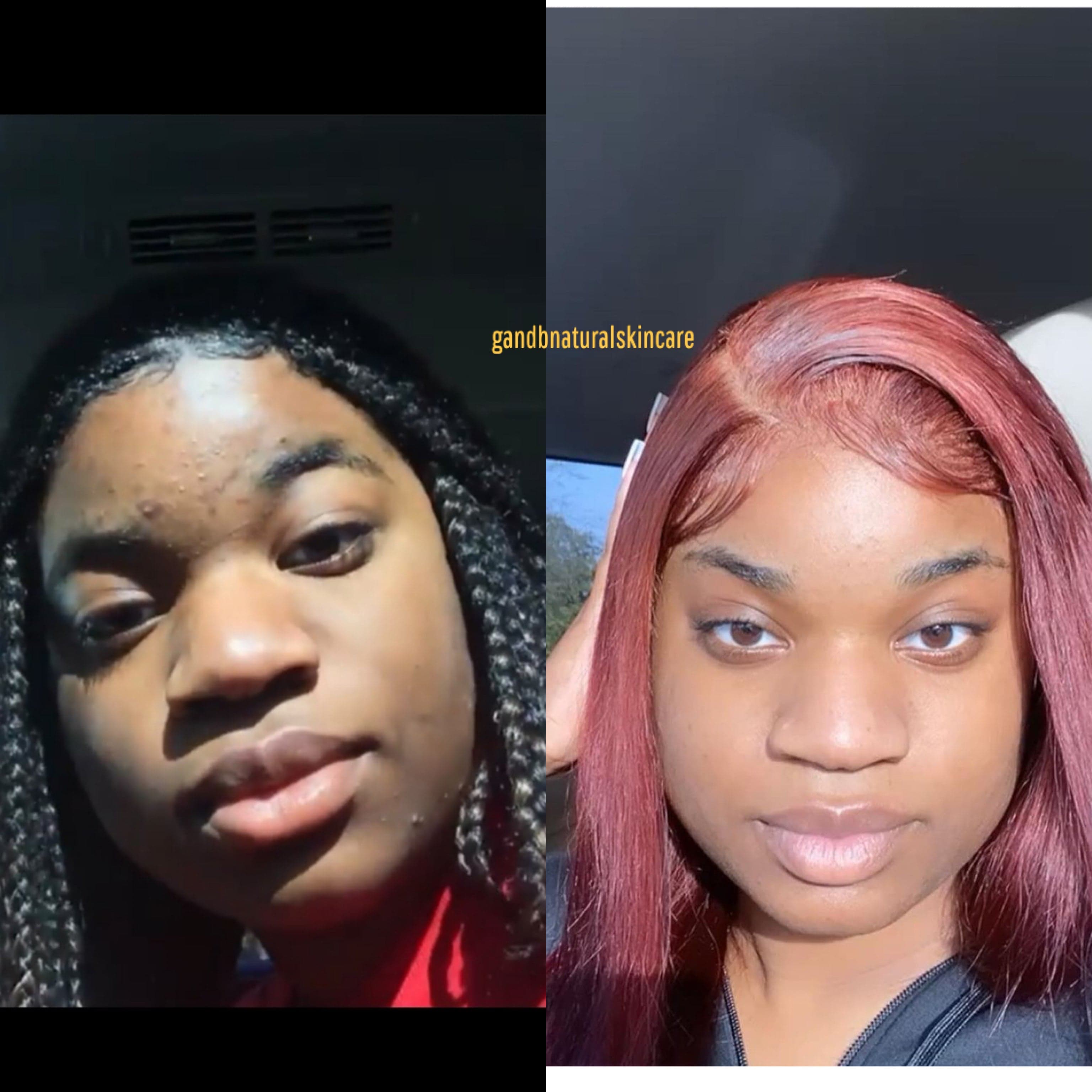 Acne & Breakouts results