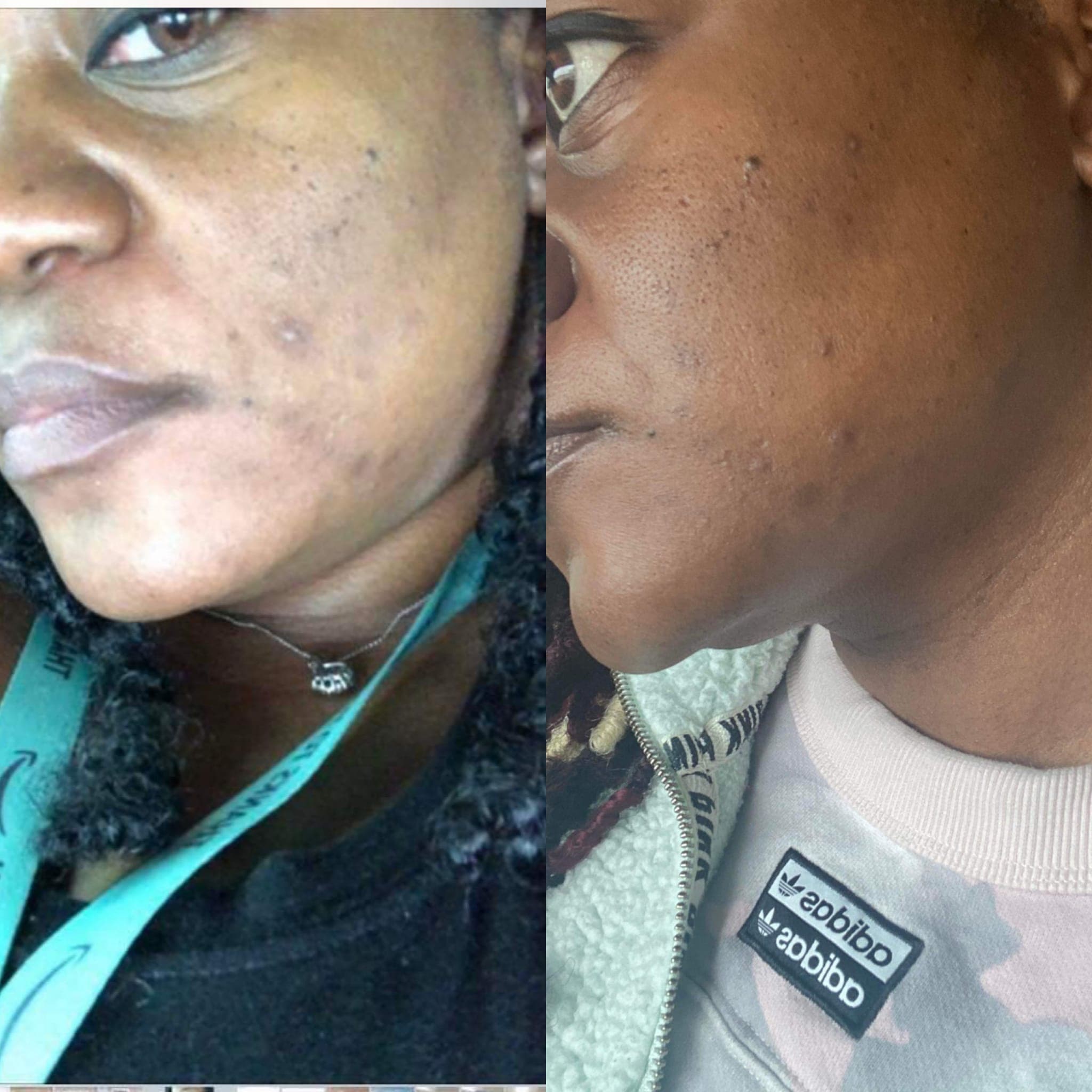 Dark Spots & Scarring results